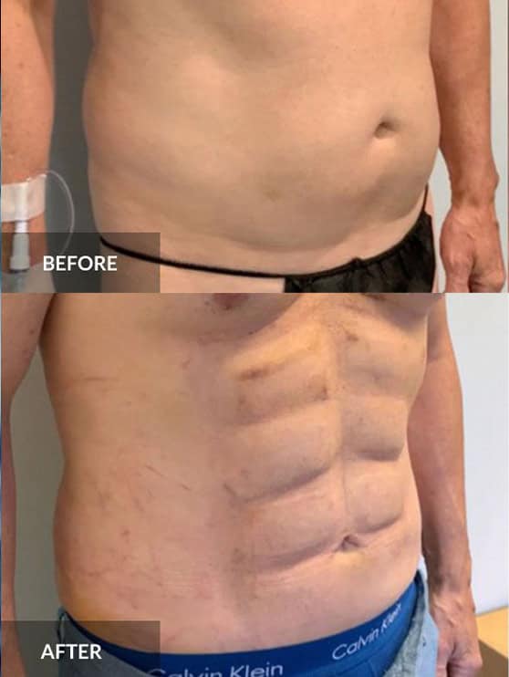 Six pack surgery for men Albania