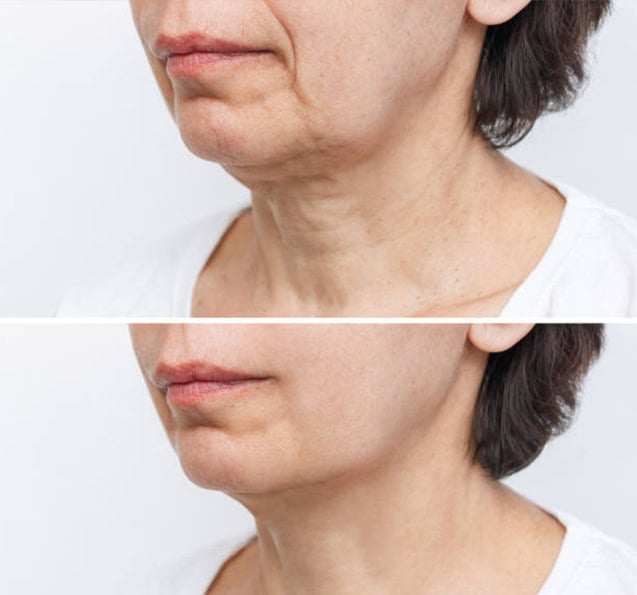 before anf after facial contouring in Albania