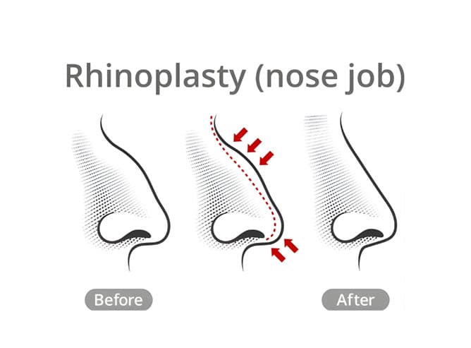 Chirurgia del naso per uomini Albania