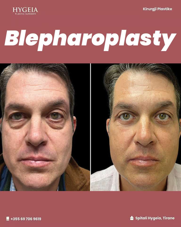 Before and after Blepharoplasty in Albania as a Male