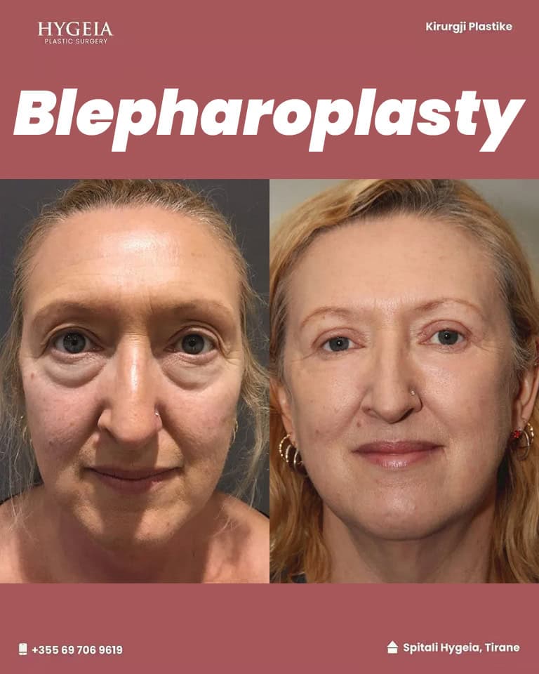 Before and after Blepharoplasty in Albania