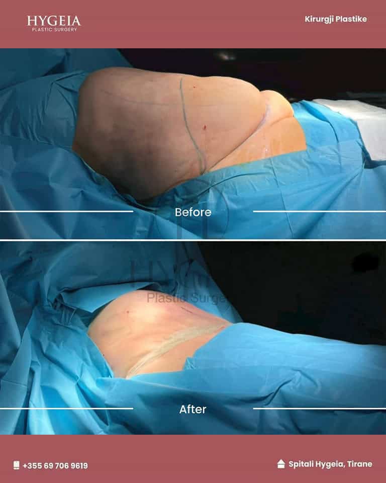 Before and after liposuction in Albania