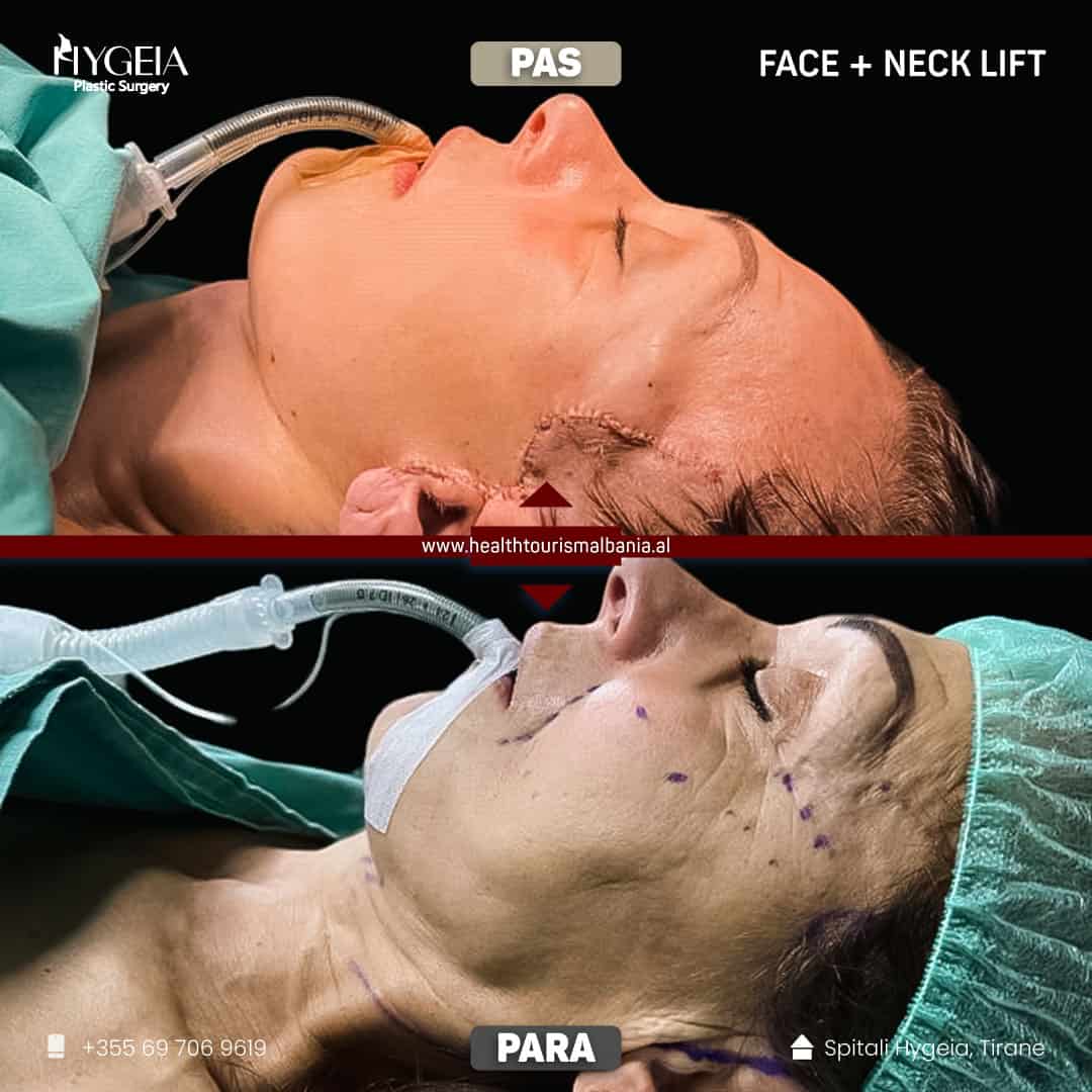 Before and after neck lift 