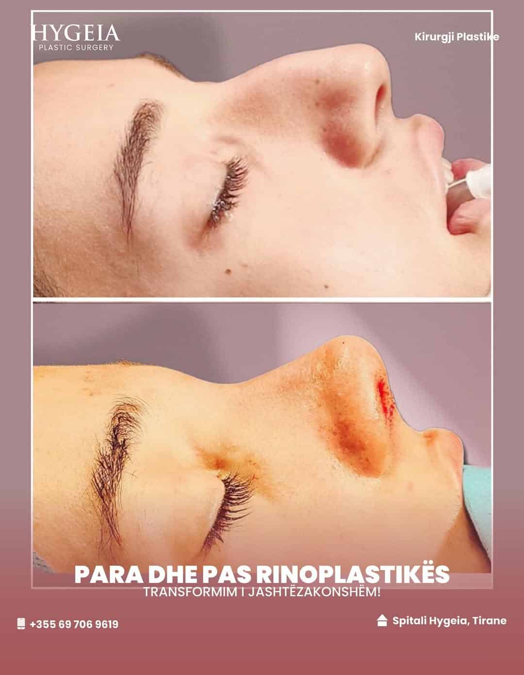 Para dhe pas rinoplastikës në Shqipëri