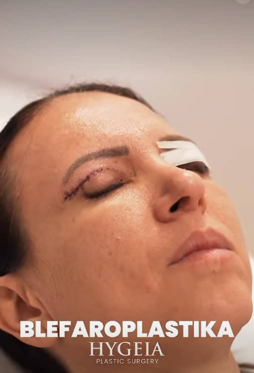 Blepharoplasty in Albania