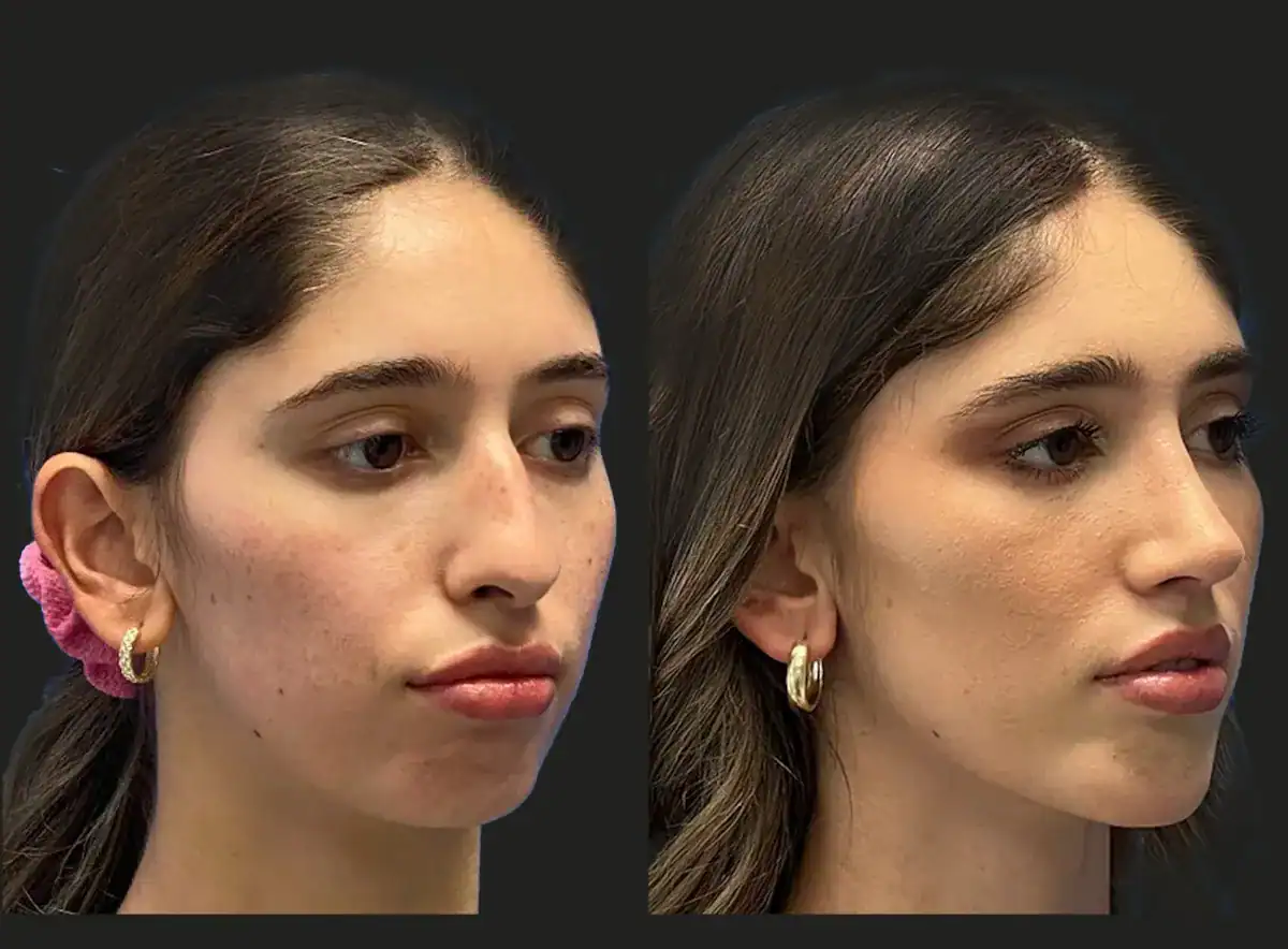 Chin Augmentation Procedure