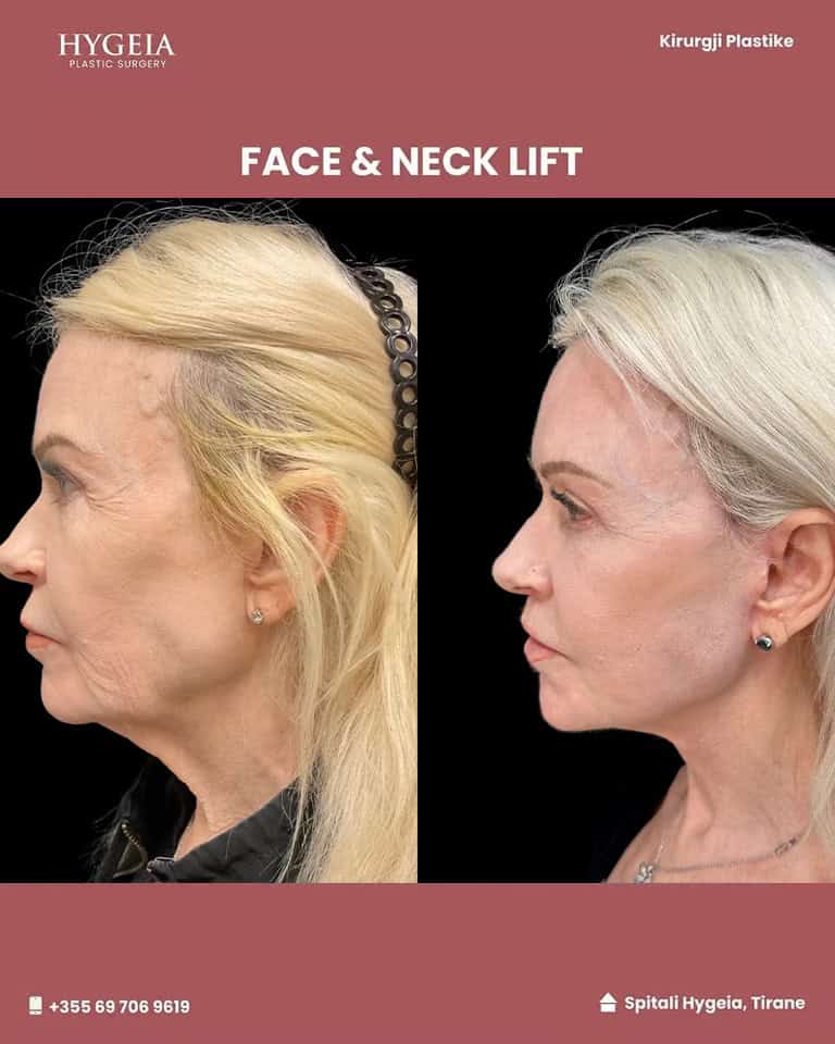 Face & neck lift at Hygeia Hospital in Albania