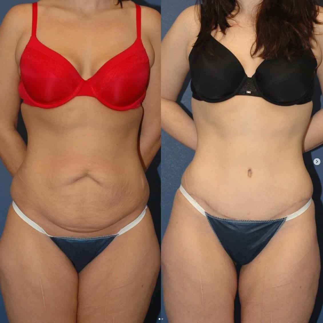 Mami Manovrimi në Shqipëri me rezultate të mahnitshme