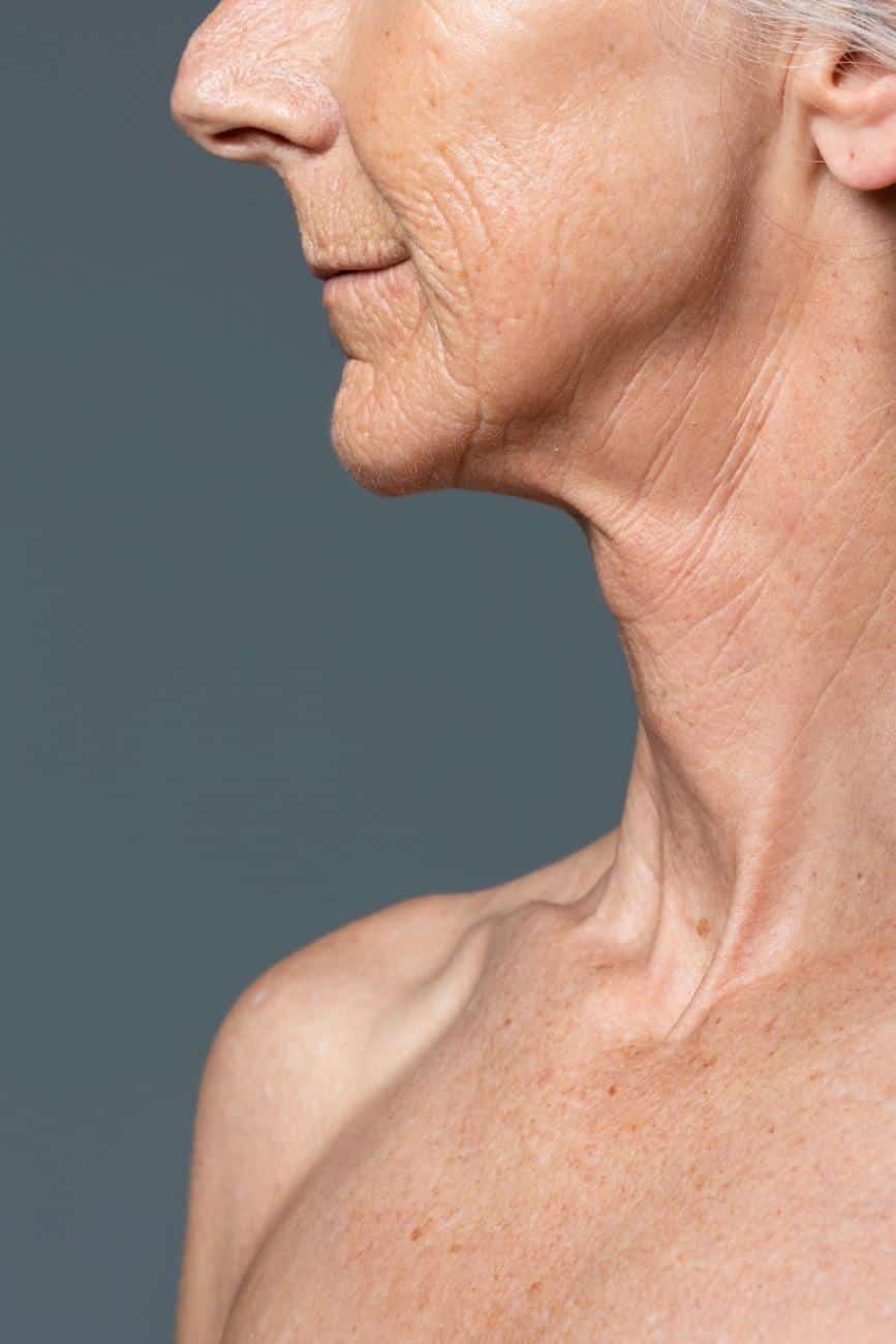 Neck Lift candidate