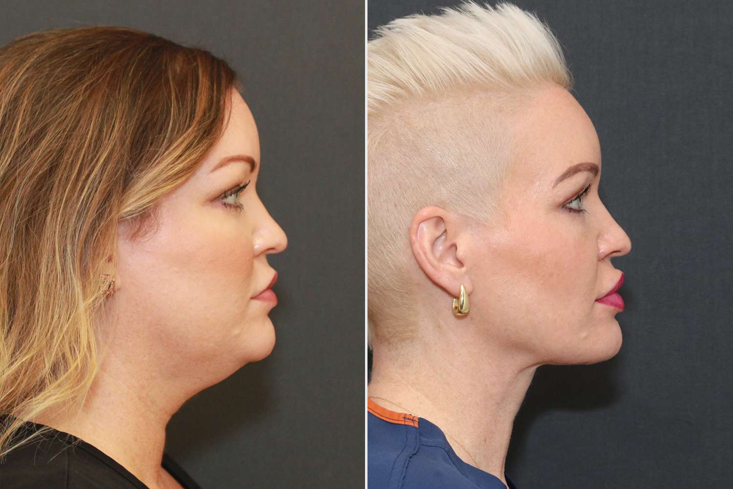 Neck lift results