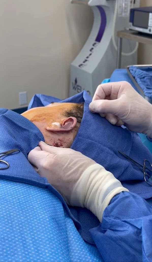 Kirurgji otoplastike