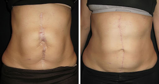 Scar Revision surgery results in Albania