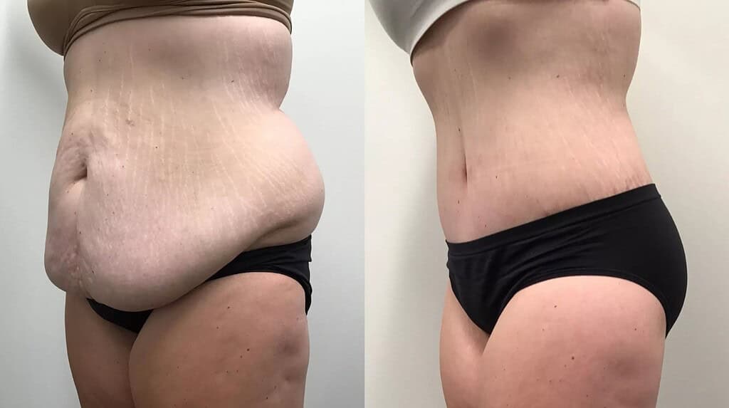 Rezultatet e abdominoplastikës që tregojnë heqje të konsiderueshme të lëkurës së barkut dhe konturim.