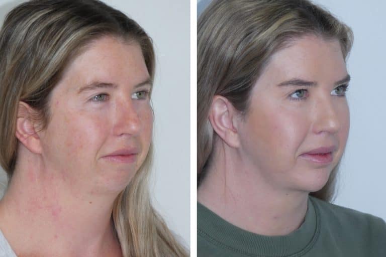 Suitable patient for chin augmentation