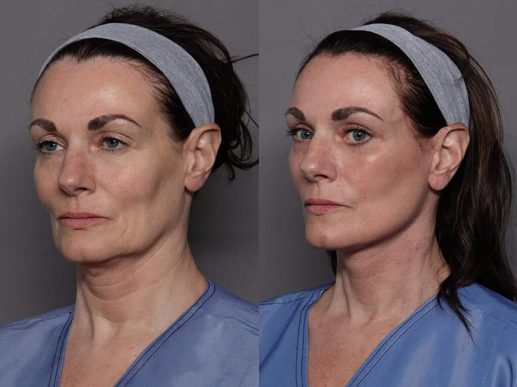 Suitable patient for facelift showing before and aafter results