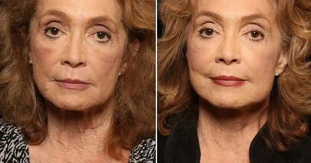 The neck lift procedure results in a woman