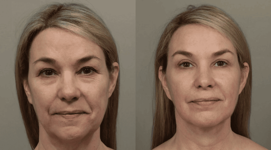 Face reshaping after weight loss Albania