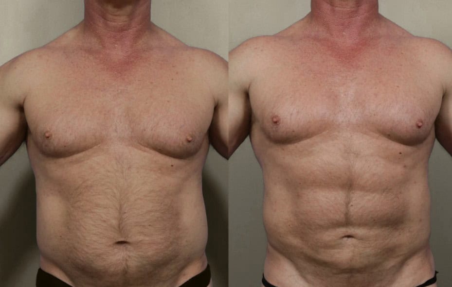 High definition liposuction in Albania