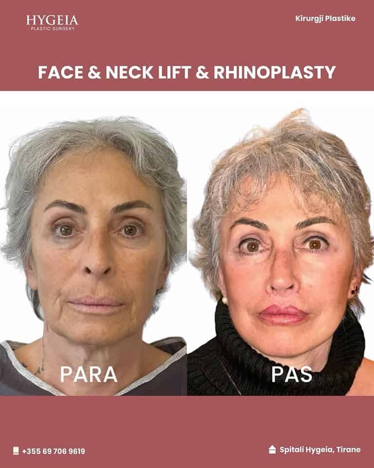 before and after neck lift in Albania
