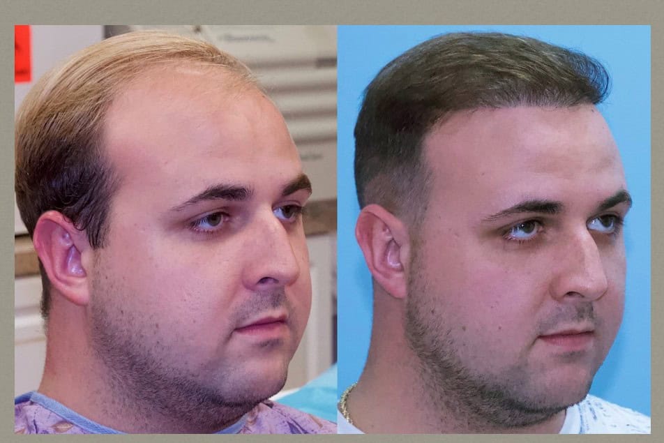 Shkëlqyeshme para dhe pas transformimit të transplantimit të flokëve