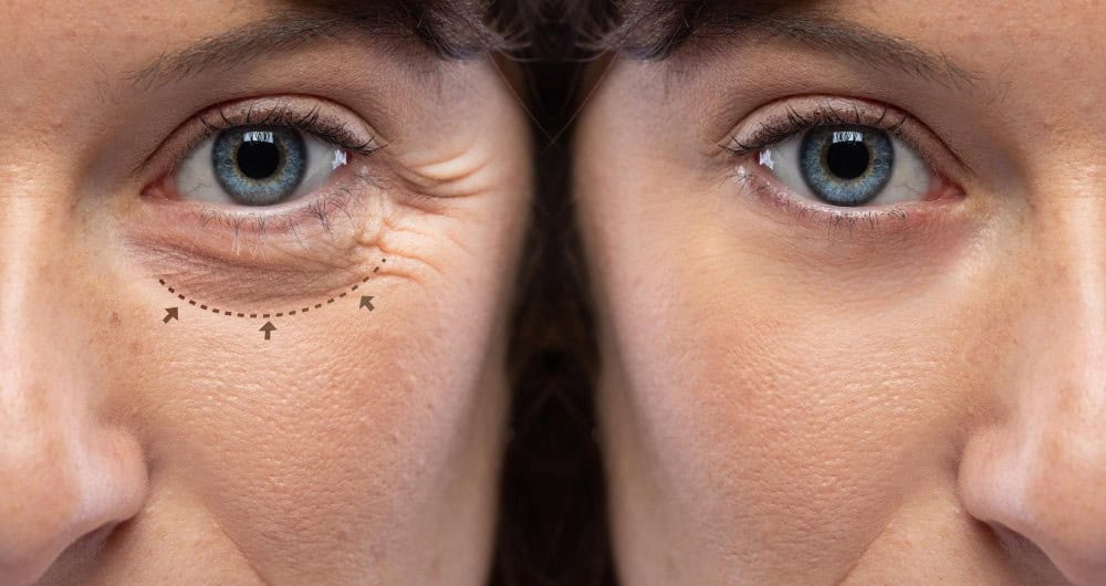 Close-up of woman’s eyes showing eyelid improvement after blepharoplasty in Albania.