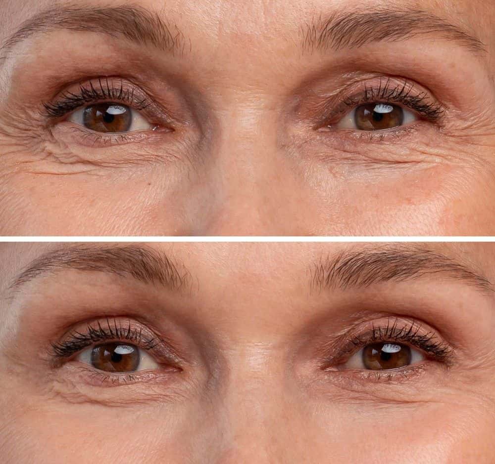 Close-up of woman's eyes showing eyelid improvement after surgery.