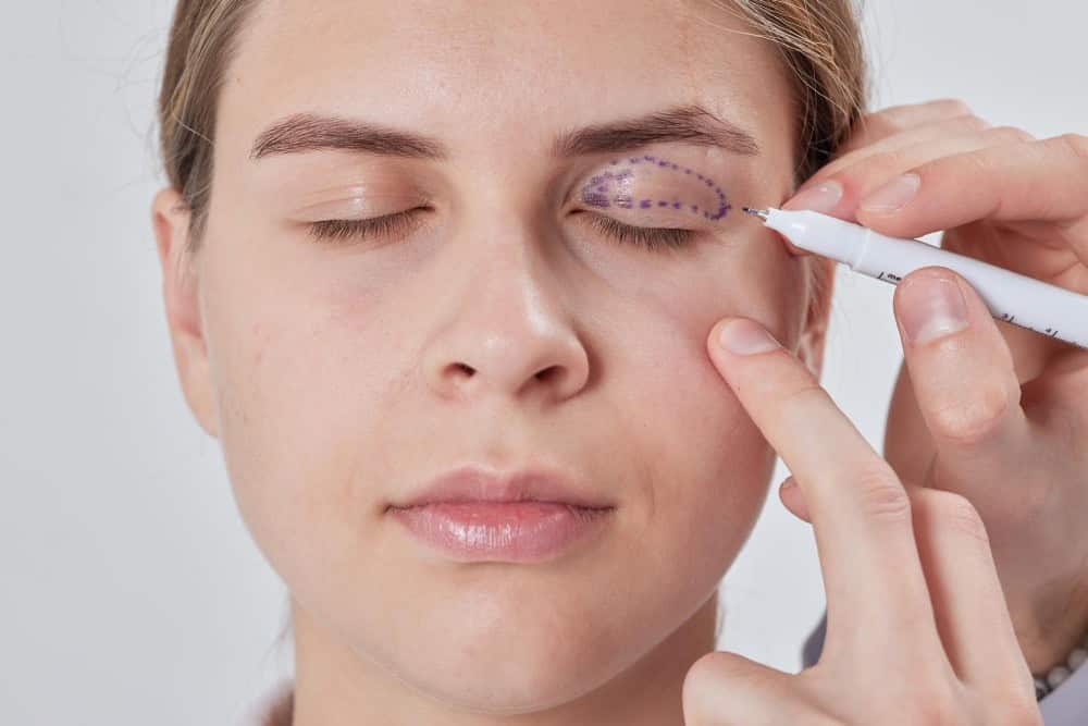 Doctor marking patient's eyelid for blepharoplasty in Albania.