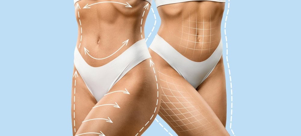 Body contouring illustration showing how liposuction and tummy tuck procedures reshape the waist and abdomen