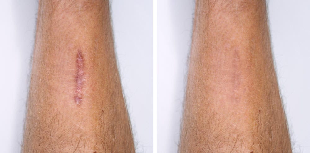 Scar revision plastic surgery for skin scar correction in Albania, expert medical treatment.