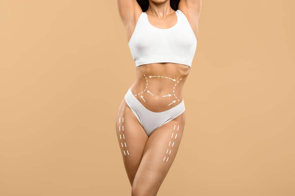 Woman with marked abdomen and hips for body contouring and liposuction in Albania.