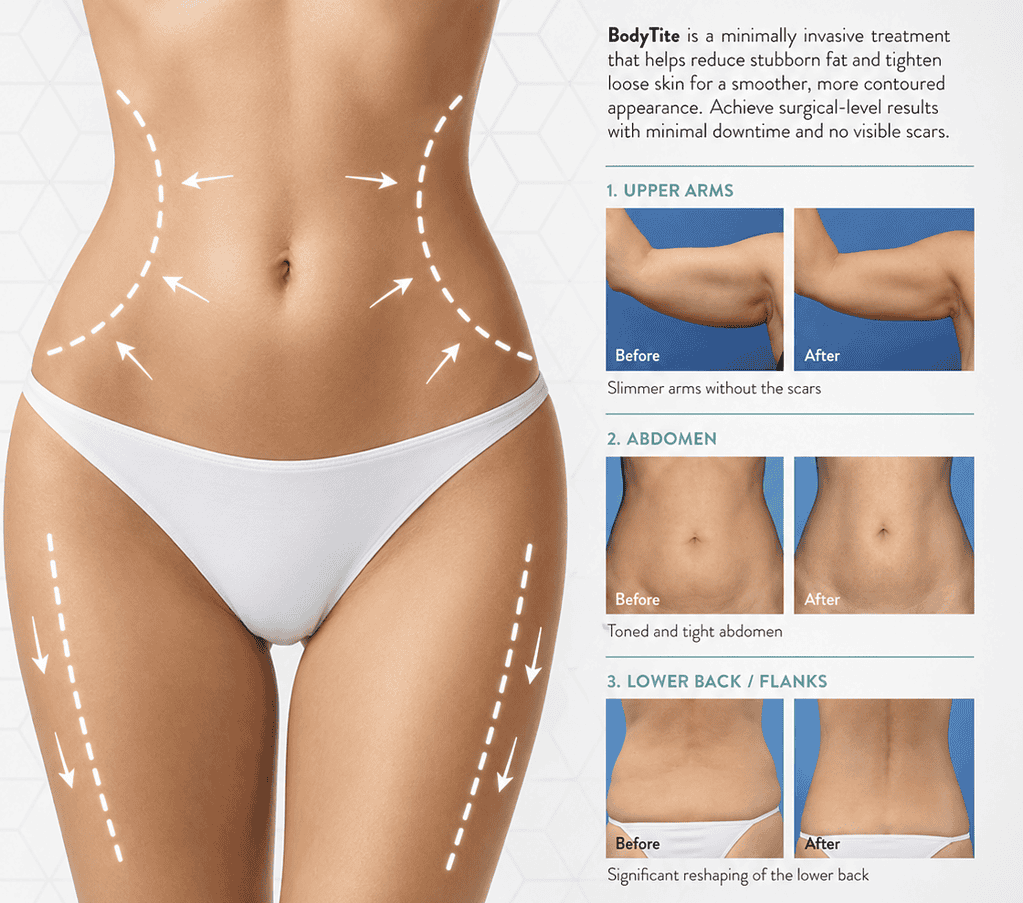 BodyTite minimally invasive fat reduction and skin tightening procedure in Albania.