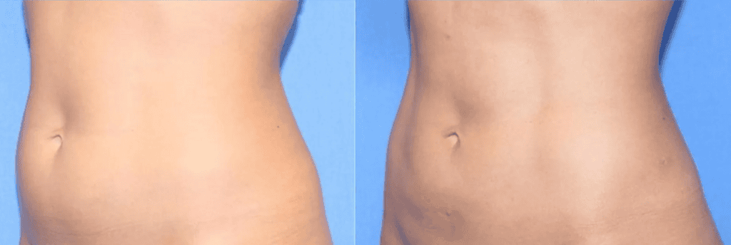 BodyTite body contouring and fat reduction in Albania for effective liposuction results.