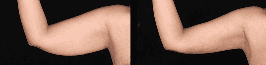 BodyTite liposuction treatment for arm contouring in Albania, minimally invasive plastic surgery.