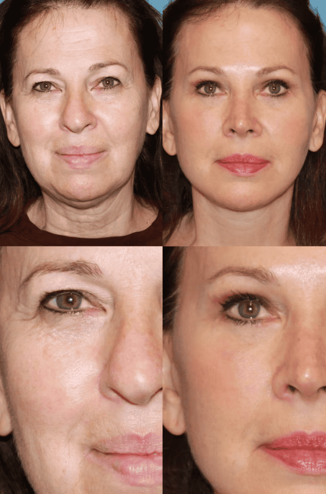 Plastic surgery brow lift before and after for eye and face rejuvenation in Albania.