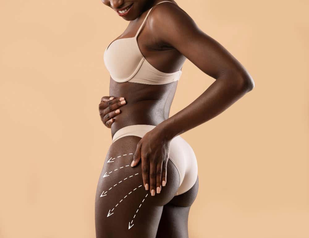 Il Brazilian Butt Lift (BBL) è sicuro? Rischi, sicurezza e cosa aspettarsi