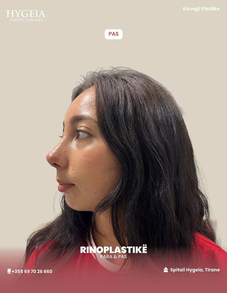 Patient after rhinoplasty in Albania, showcasing successful plastic surgery results.