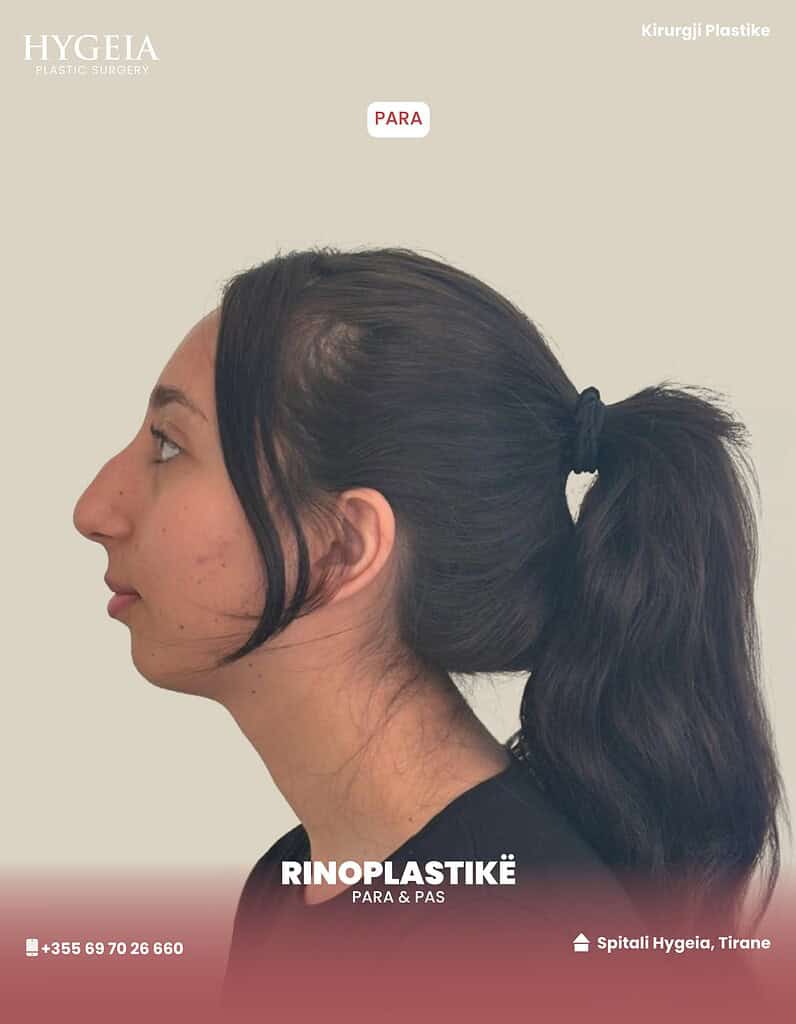Rhinoplasty before-and-after in Albania for plastic surgery and nose reshaping.