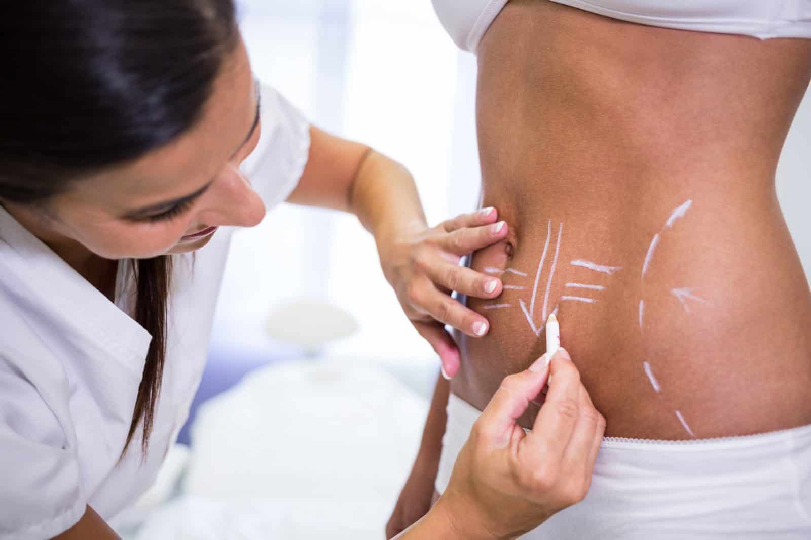 abdominoplasty after pregnancy consultation