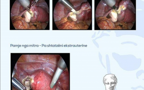 Shtatzënia Ekstrauterine(barra jashtë mitre)